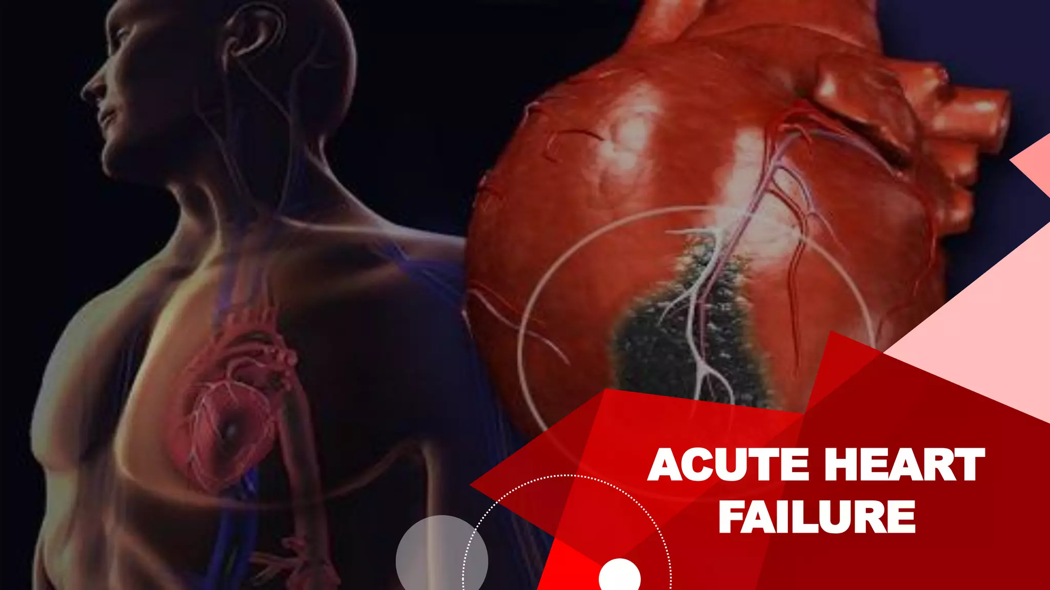 ACUTE HEART
FAILURE
 
