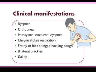 Clinical manifestations
▪ Dyspnea
▪ Orthopnea
▪ Paroxysmal nocturnal dyspnea
▪ Cheyne stokes respiration.
▪ Frothy or blood tinged hacking cough
▪ Bilateral crackles
▪ Gallop
 