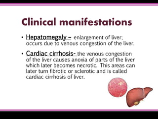 Clinical manifestations
▪ Hepatomegaly – enlargement of liver;
occurs due to venous congestion of the liver.
▪ Cardiac cirrhosis- the venous congestion
of the liver causes anoxia of parts of the liver
which later becomes necrotic. This areas can
later turn fibrotic or sclerotic and is called
cardiac cirrhosis of liver.
 