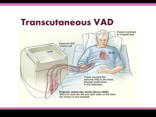 Transcutaneous VAD
 