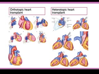 Orthotopic heart
transplant
Heterotopic heart
transplant
 