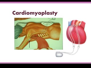 Cardiomyoplasty
 