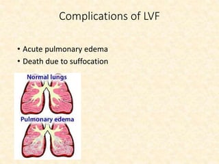 Complications of LVF
• Acute pulmonary edema
• Death due to suffocation
 