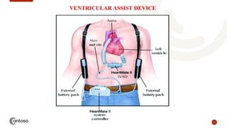 31
VENTRICULAR ASSIST DEVICE
 