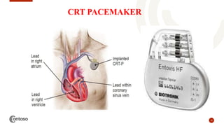 32
CRT PACEMAKER
 