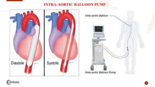 33
INTRA-AORTIC BALLOON PUMP
 