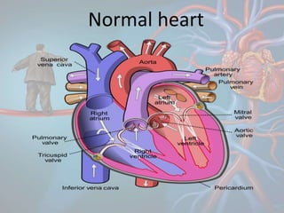 Normal heart
 