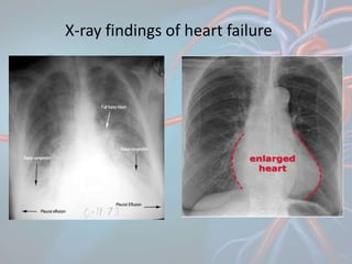 X-ray findings of heart failure
 