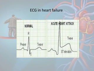 ECG in heart failure
 
