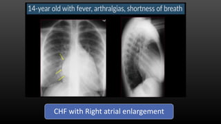CHF with Right atrial enlargement
 