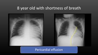 8 year old with shortness of breath
Pericardial effusion
 