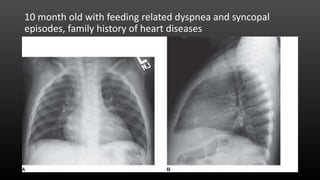 10 month old with feeding related dyspnea and syncopal
episodes, family history of heart diseases
 
