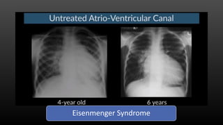 Eisenmenger Syndrome
 