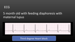 5 month old with feeding diaphoresis with
maternal lupus
ECG
Third degree Heart block
 