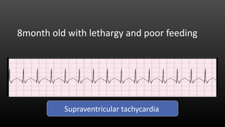 8month old with lethargy and poor feeding
Supraventricular tachycardia
 