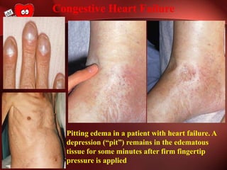 Pitting edema in a patient with heart failure. A
depression (“pit”) remains in the edematous
tissue for some minutes after firm fingertip
pressure is applied
Congestive Heart Failure
 