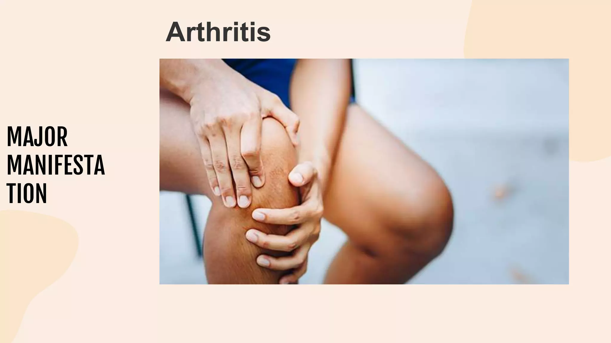 MAJOR
MANIFESTA
TION
Arthritis
 