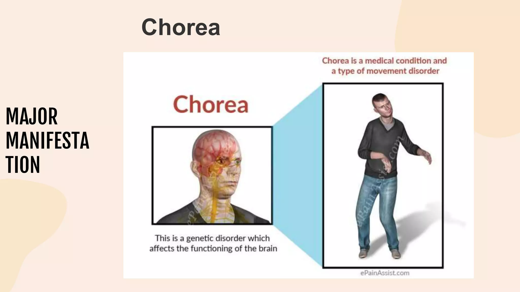 MAJOR
MANIFESTA
TION
Chorea
 