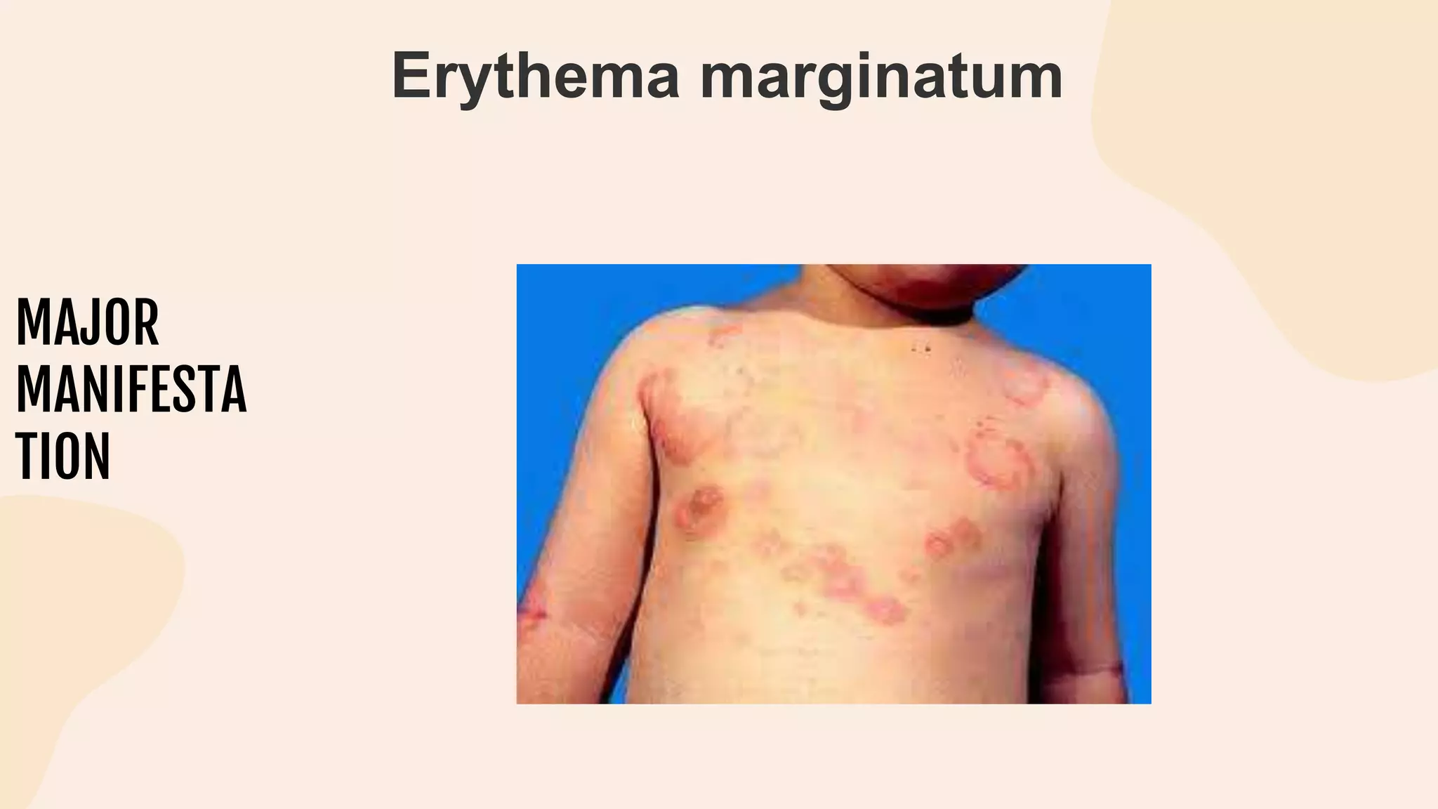 MAJOR
MANIFESTA
TION
Erythema marginatum
 