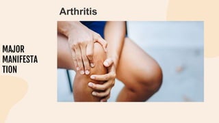 MAJOR
MANIFESTA
TION
Arthritis
 