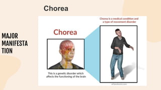 MAJOR
MANIFESTA
TION
Chorea
 