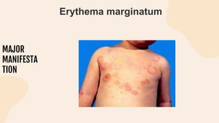 MAJOR
MANIFESTA
TION
Erythema marginatum
 