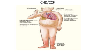 CHD/CCF
 