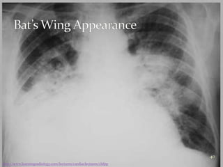 Heart failure radiology group1 year 5 10-11 | PPTX