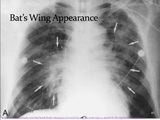 Heart failure radiology group1 year 5 10-11 | PPTX