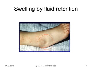 Swelling by fluid retention




March 2013            ghennersdorf DGK ESC SES   10
 