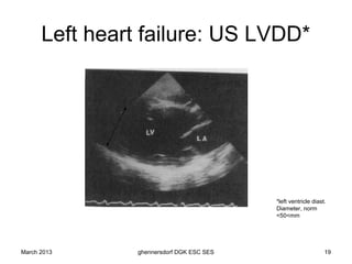 Left heart failure: US LVDD*




                                           *left ventricle diast.
                                           Diameter, norm
                                           <50<mm




March 2013      ghennersdorf DGK ESC SES                        19
 