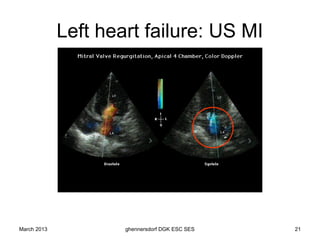Left heart failure: US MI




March 2013           ghennersdorf DGK ESC SES   21
 