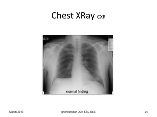 Chest XRay CXR




                  normal finding




March 2013     ghennersdorf DGK ESC SES   24
 