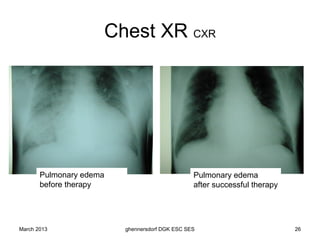 Chest XR CXR




       Pulmonary edema                          Pulmonary edema
       before therapy                           after successful therapy




March 2013               ghennersdorf DGK ESC SES                          26
 