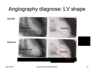 Angiography diagnose: LV shape
 Systole


             Regional scar                                  Diastole



                                                                           EF < 20%
                                                                           red lines
 Diastole                                                                  show normal
                                                                           contraction


             Regional scar
                                                            Systole


              Anterior wall infarction
                                                  Dilated cardiomyopathy

March 2013                       ghennersdorf DGK ESC SES                           33
 