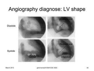 Angiography diagnose: LV shape
                                                  Regional scar


 Diastole




                                                  Regional scar


 Systole
             EF 70%
              normal                               infarction



March 2013             ghennersdorf DGK ESC SES                   34
 