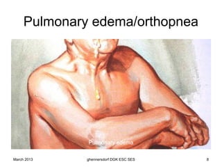 Pulmonary edema/orthopnea




              Pulmonary edema

March 2013    ghennersdorf DGK ESC SES   8
 