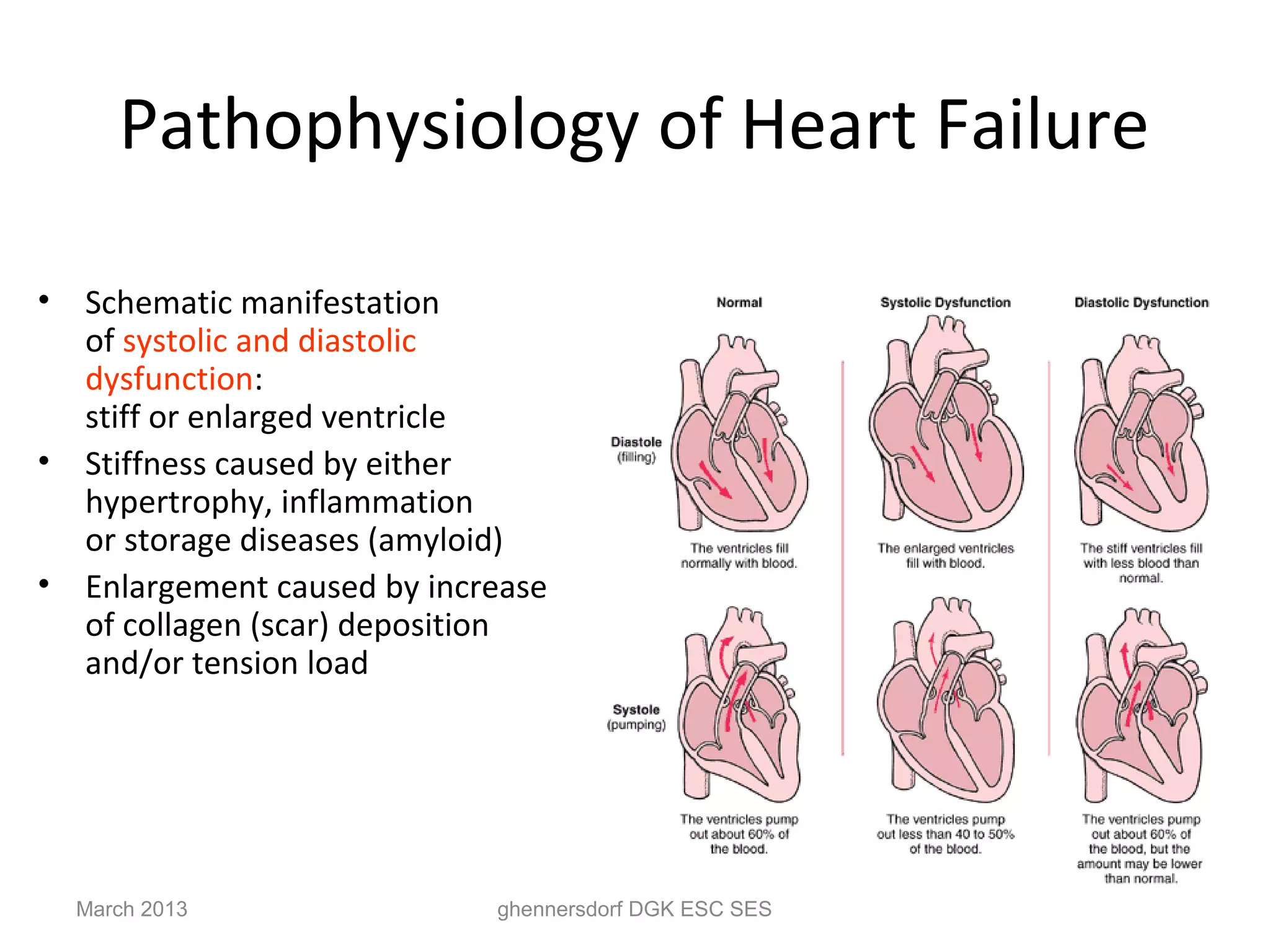 Pathophysiology of Heart Failure

• Schematic manifestation
  of systolic and diastolic
  dysfunction:
  stiff or enlarged ventricle
• Stiffness caused by either
  hypertrophy, inflammation
  or storage diseases (amyloid)
• Enlargement caused by increase
  of collagen (scar) deposition
  and/or tension load




  March 2013                ghennersdorf DGK ESC SES
 