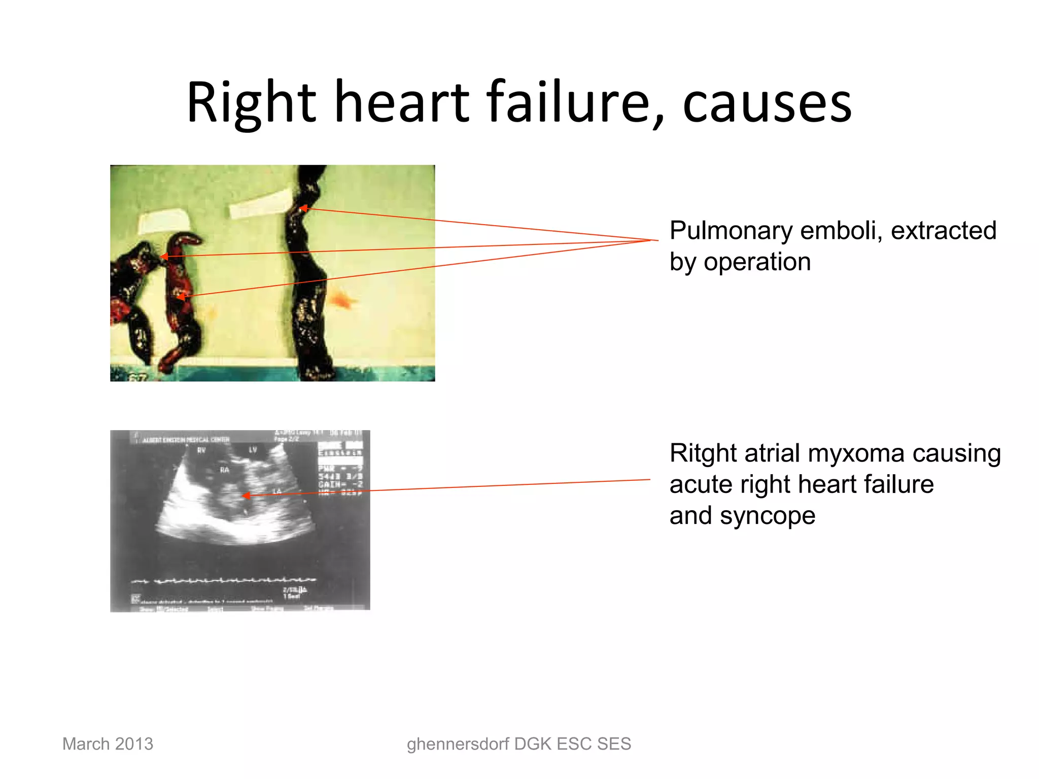 Right heart failure, causes
                                                Pulmonary emboli, extracted
                                                by operation




                                                Ritght atrial myxoma causing
                                                acute right heart failure
                                                and syncope




March 2013           ghennersdorf DGK ESC SES
 