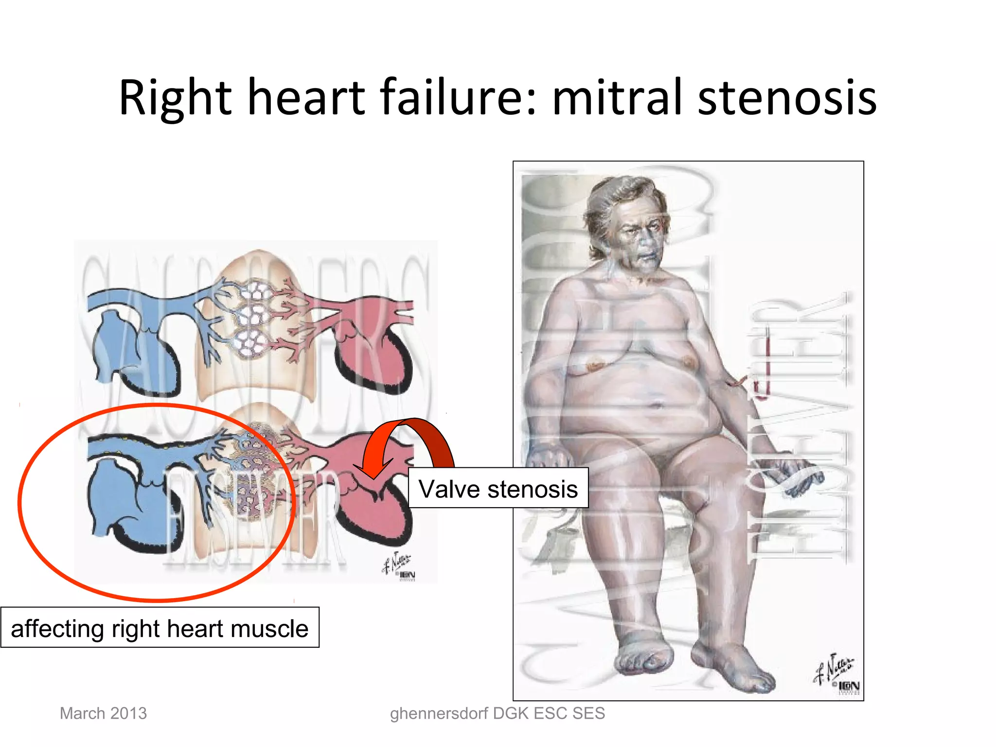 Right heart failure: mitral stenosis




                                  Valve stenosis




affecting right heart muscle


    March 2013                 ghennersdorf DGK ESC SES
 