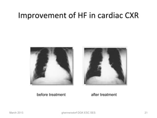 Improvement of HF in cardiac CXR




             before treatment                 after treatment



March 2013                ghennersdorf DGK ESC SES              21
 