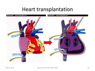 Heart transplantation




March 2013         ghennersdorf DGK ESC SES   25
 