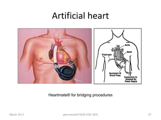 Artificial heart




             Heartmate® for bridging procedures



March 2013          ghennersdorf DGK ESC SES      27
 