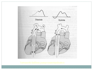 Intraaortic balloon pump counterpulsation
 