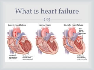 
What is heart failure
 