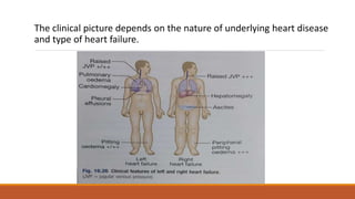 The clinical picture depends on the nature of underlying heart disease
and type of heart failure.
 