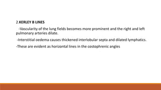 2.KERLEY B LINES
-Vascularity of the lung fields becomes more prominent and the right and Ieft
pulmonary arteries dilate.
-Interstitial oedema causes thickened interlobular septa and dilated lymphatics.
-These are evident as horizontal lines in the costophrenic angles
 