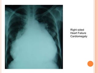 Right sided
Heart Failure
Cardiomegaly
 