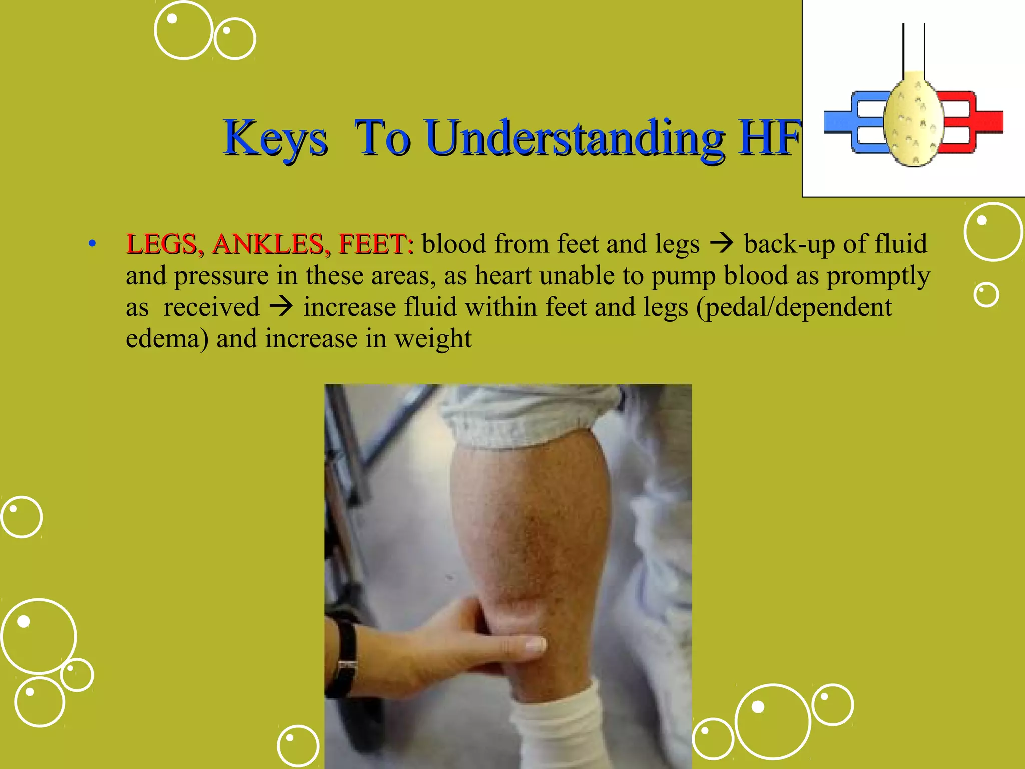 Keys To Understanding HF
• LEGS, ANKLES, FEET: blood from feet and legs  back-up of fluid
and pressure in these areas, as heart unable to pump blood as promptly
as received  increase fluid within feet and legs (pedal/dependent
edema) and increase in weight

 