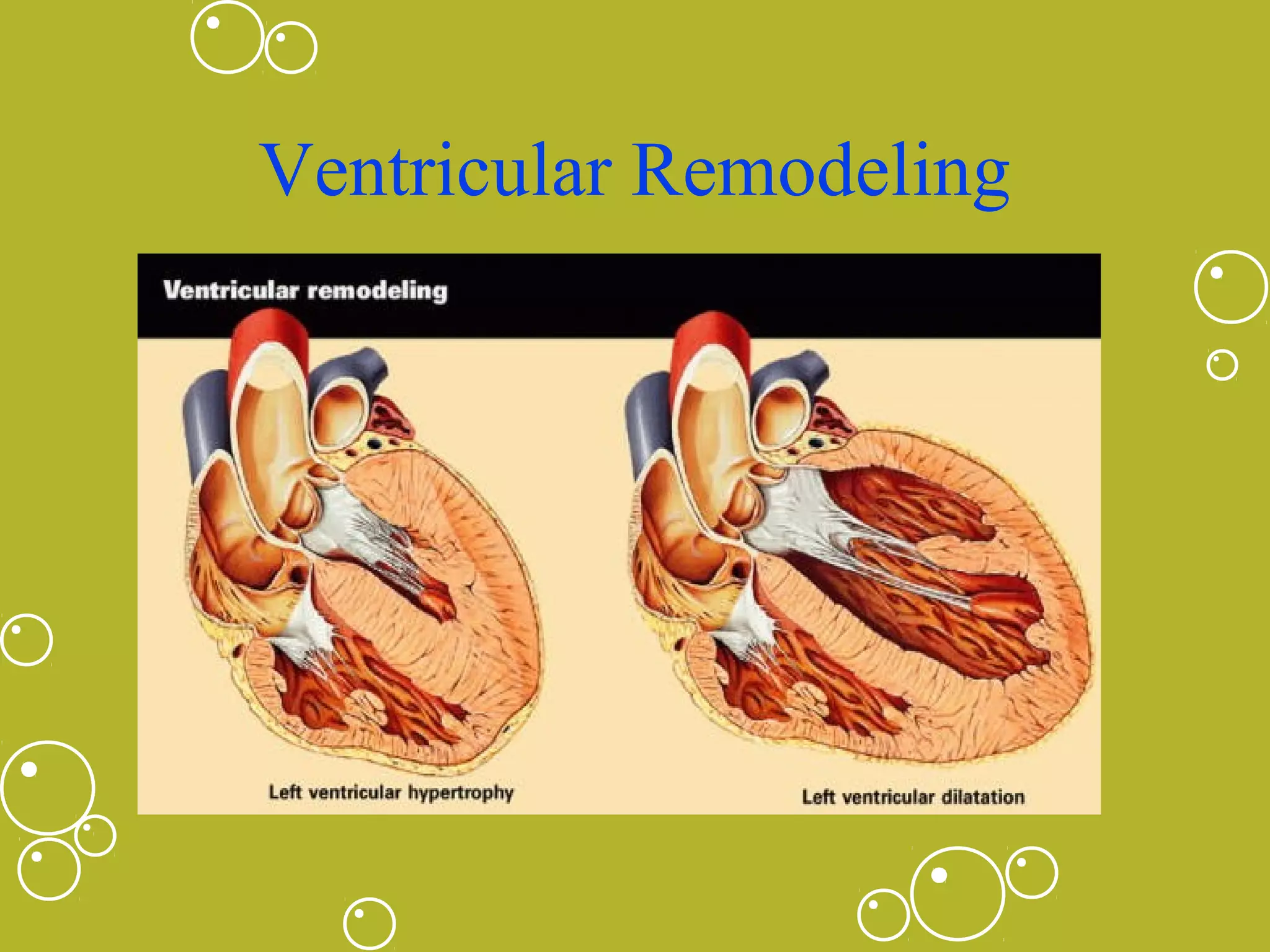 Ventricular Remodeling

 